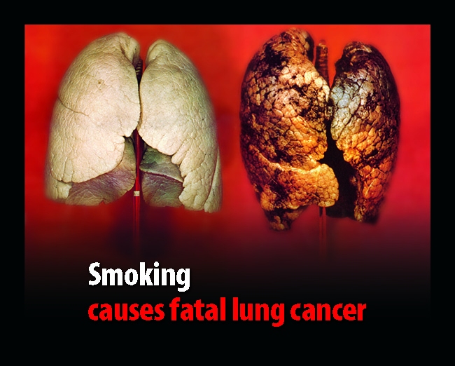 Smoking causes fatal lung cancer