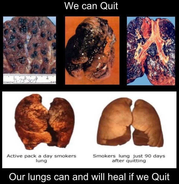 We can quit - Our lungs can and will heal if we quit smoking